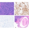 Management of Carcinoid Tumor within a Horseshoe Kidney
